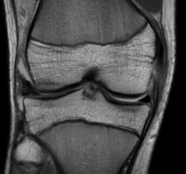 MCL Midsubstance Tear MRI 1